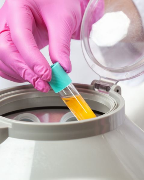 Platelet Rich Plasma (PRP) resmi