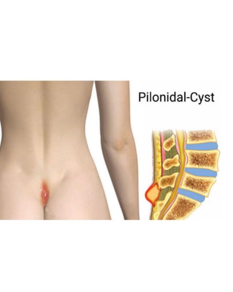 PİLONİDAL KİST EKSİZYONU (LOKAL) resmi