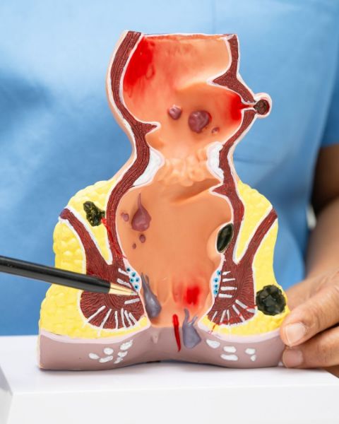 Perianal Bölge MR (Hemoroid, Fistül, Fissür) resmi